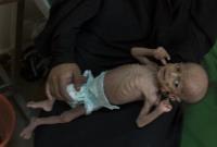 میلیونها یمنی از نبود امنیت غذایی رنج میبرند